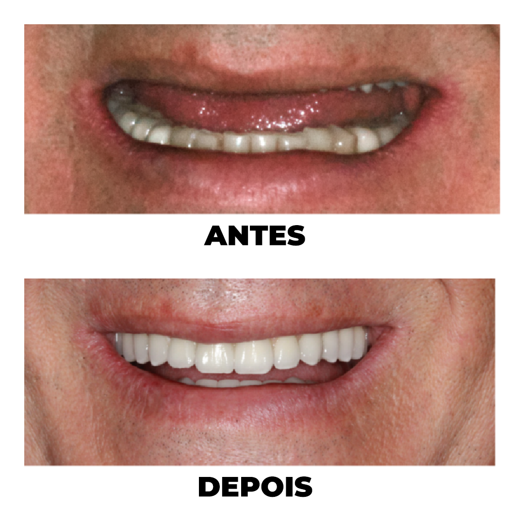 Antes e Depois de tratamento odontológico