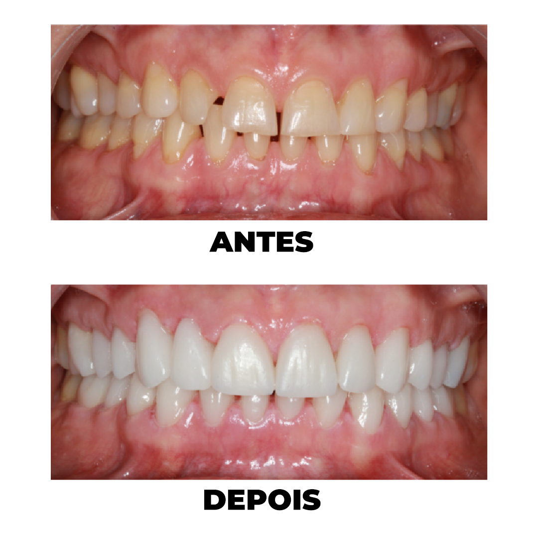 Antes e Depois de tratamento odontológico