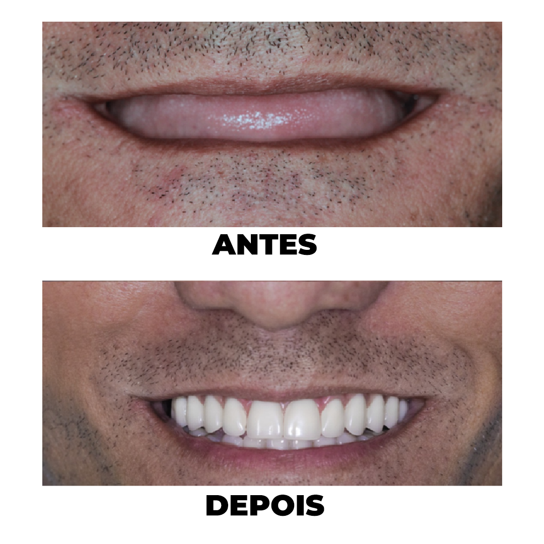 Antes e Depois de tratamento odontológico
