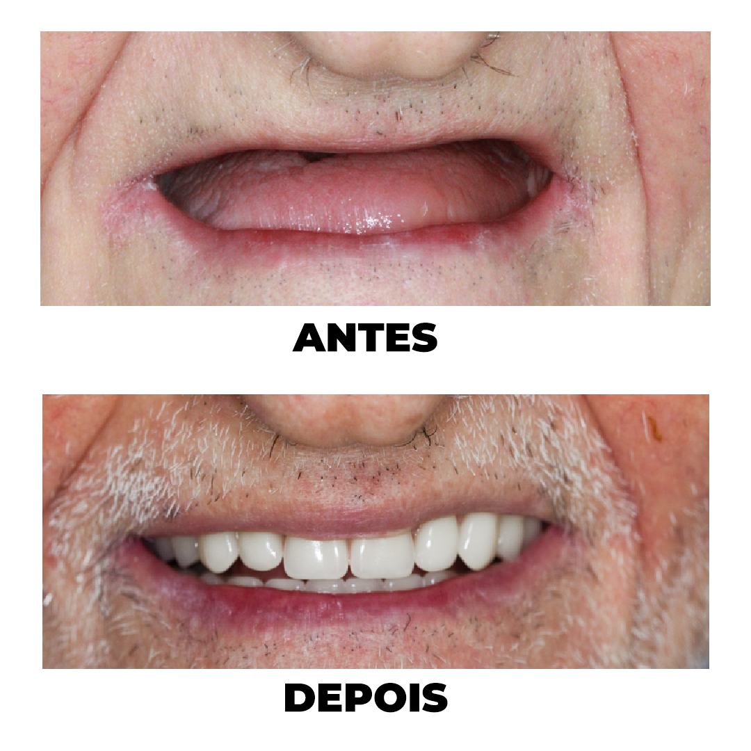 Antes e Depois de tratamento odontológico