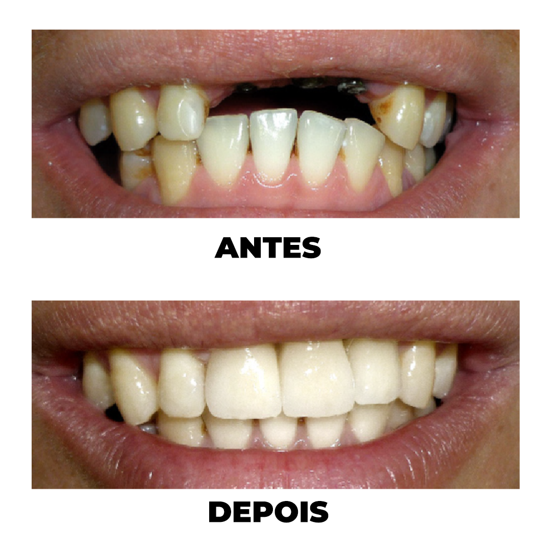 Antes e Depois de tratamento odontológico