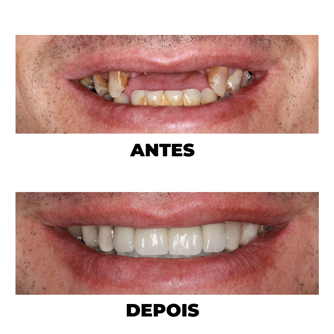 Antes e Depois de tratamento odontológico