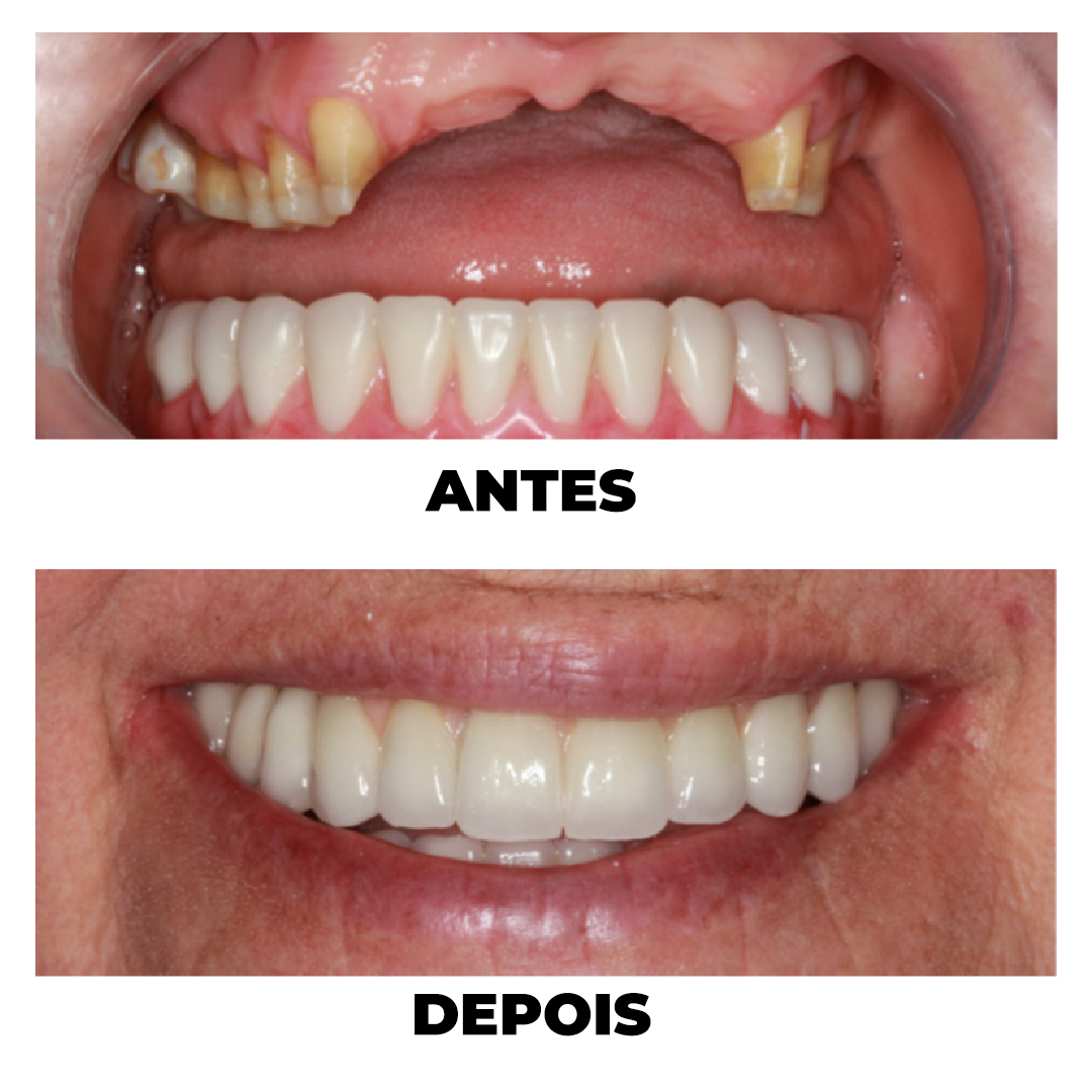 Antes e Depois de tratamento odontológico