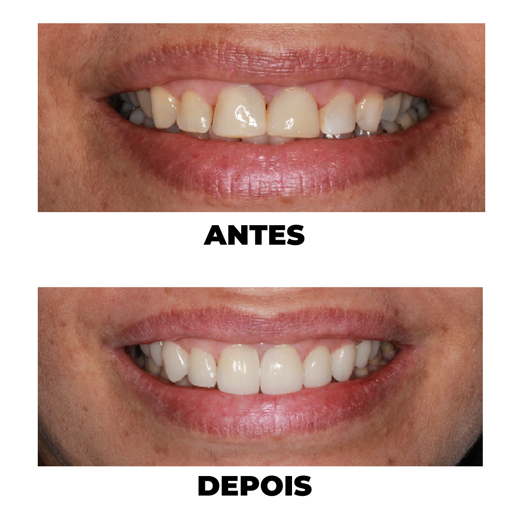 Antes e Depois de tratamento odontológico