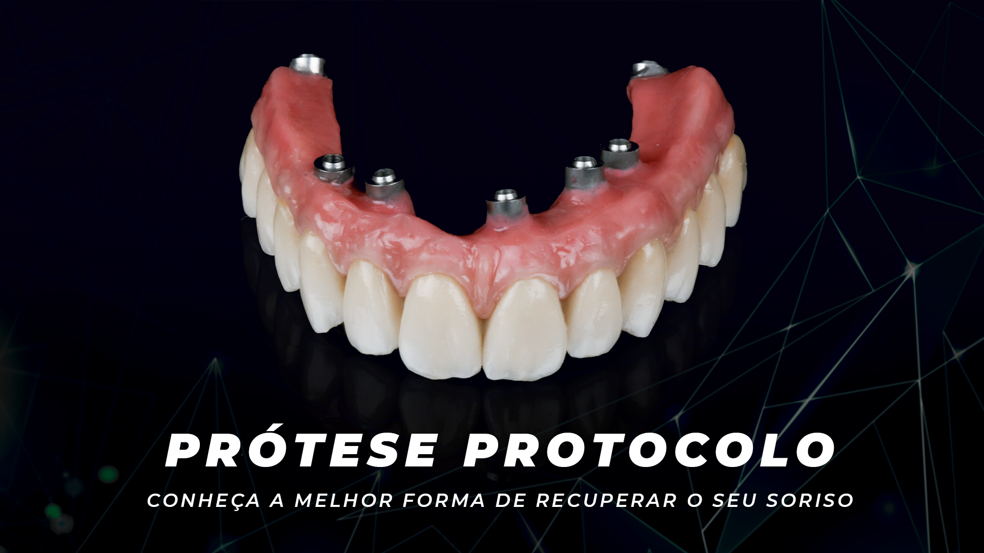 Prótese Protocolo