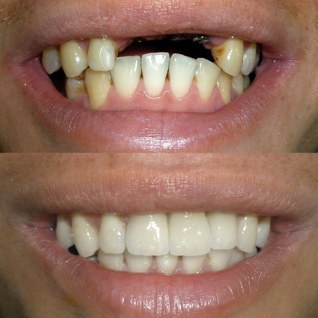 Antes e Depois Prótese Múltipla sobre Implante
